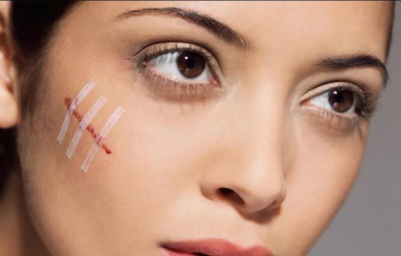 4 kiểu sẹo mạt vận kinh hoàng