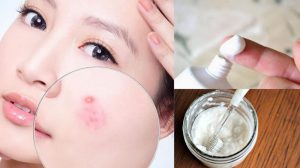 Top 10 cách trị mụn sữa ở người lớn siêu đơn giản