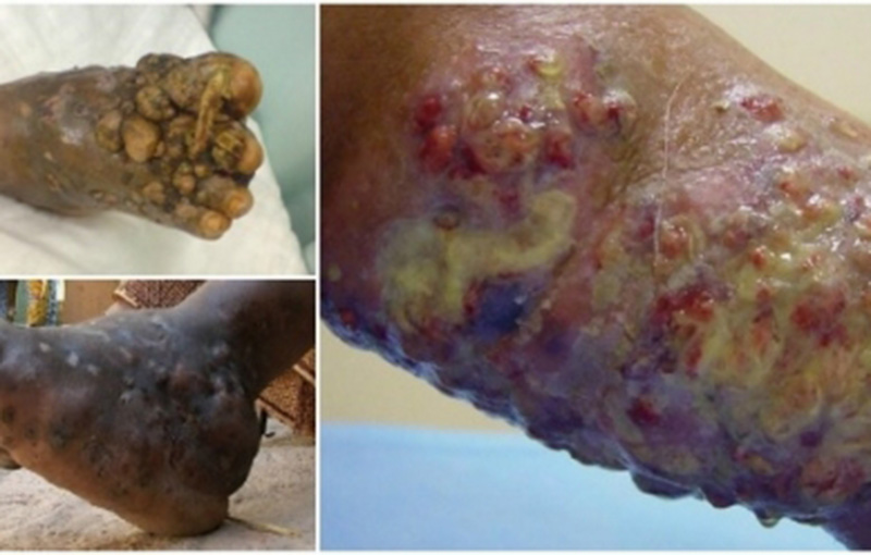 Nấm Mycetoma sẽ lan rộng gây hủy hoại phần mô chân và khiến người bệnh phải nằm, ngồi bất động một chỗ