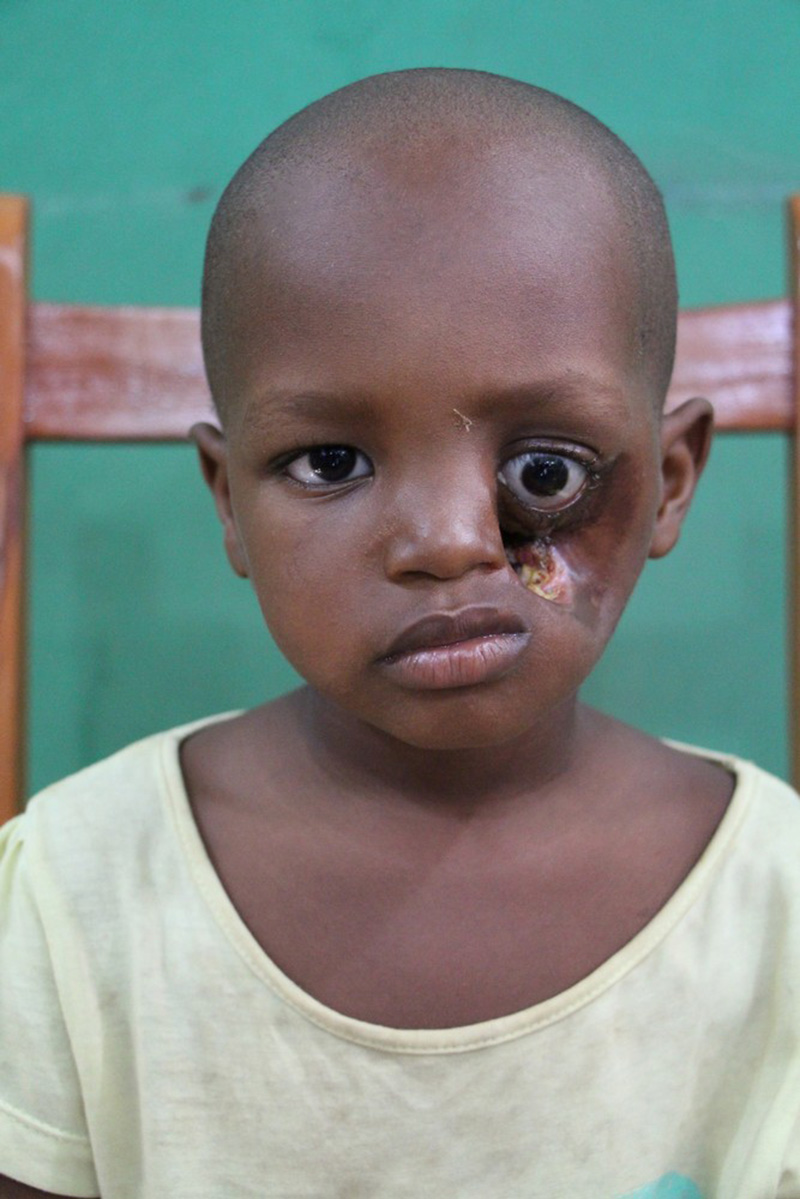 Hình ảnh bệnh nhân người châu Phi  mắc phải căn bệnh Noma đáng sợ