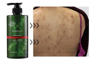 Đã tìm thấy chai sữa tắm “cứu” những tấm lưng chi chít mụn!