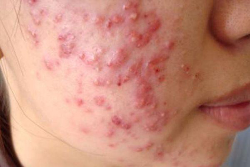 mụn sữa ở người lớn