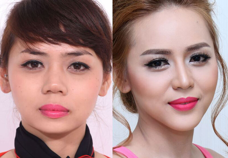 Phẫu thuật độn cằm qua lời kể của người trong cuộc!