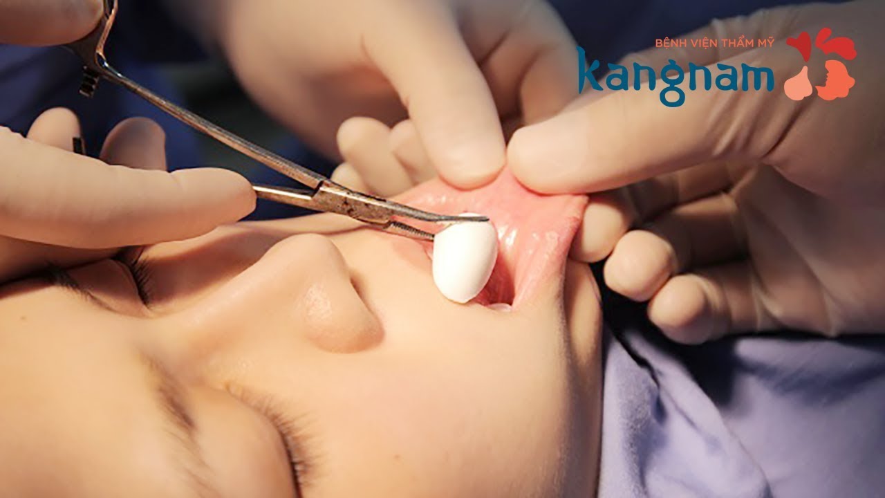 Phẫu thuật độn cằm qua lời kể của người trong cuộc! - Tâm Sự Gia Đình