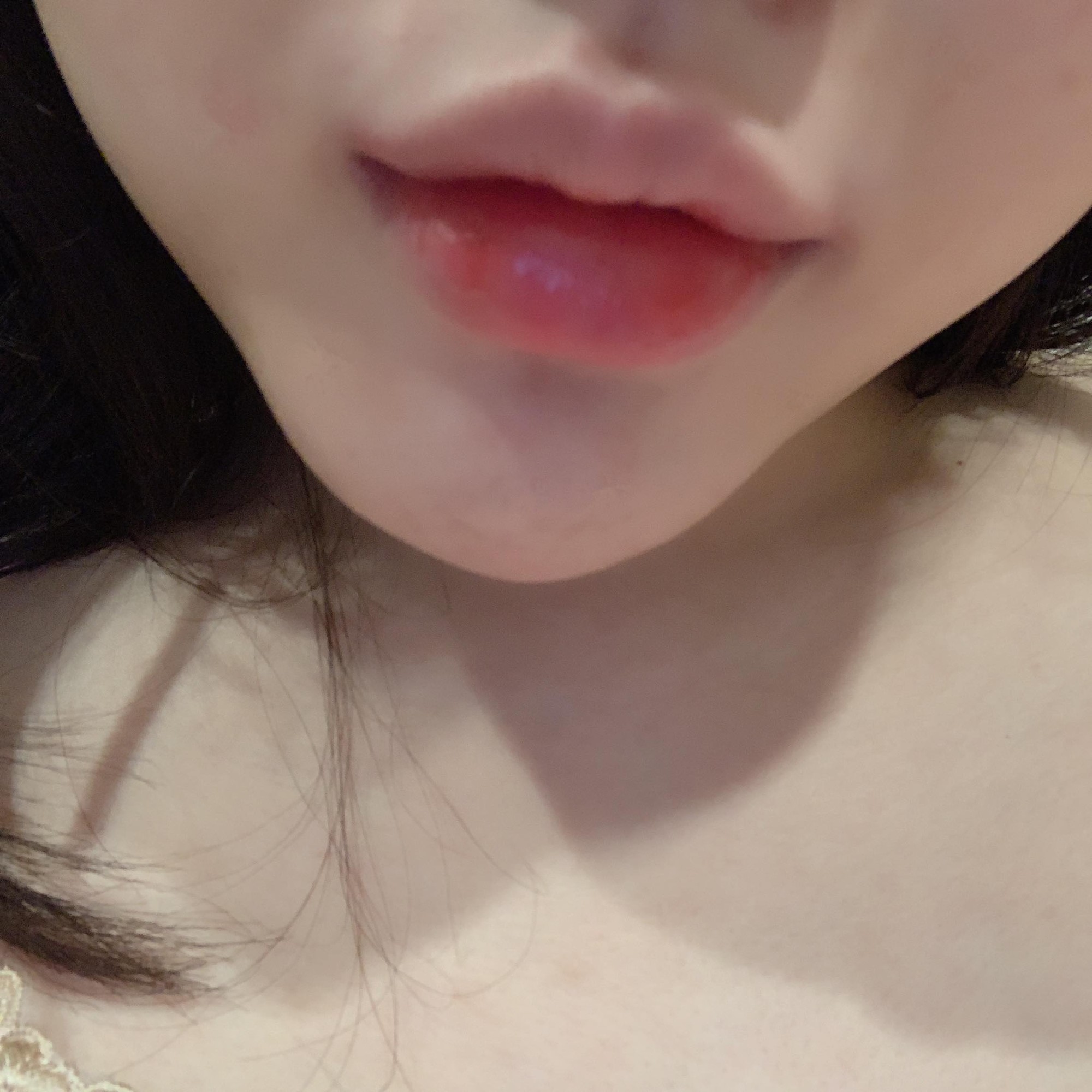 Cô gái phải tháo độn cằm vì biến chứng do tiêm chất làm đầy | Tin tức Online