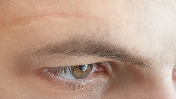 3 vị trí sẹo không nên xuất hiện trên mặt