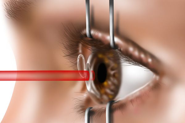 cho con bú có mổ mắt cận được không